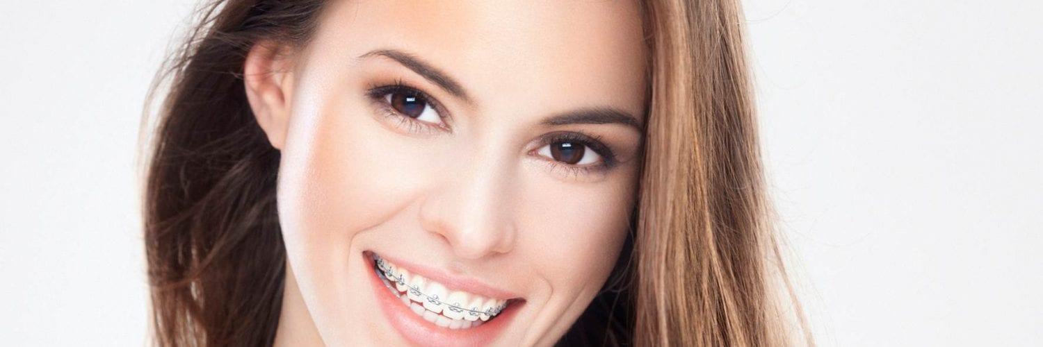 Aparelho ortodôntico: acessórios simples que podem ajudar na higiene