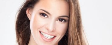 Aparelho ortodôntico: acessórios simples que podem ajudar na higiene