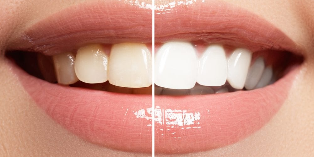como clarear os dentes