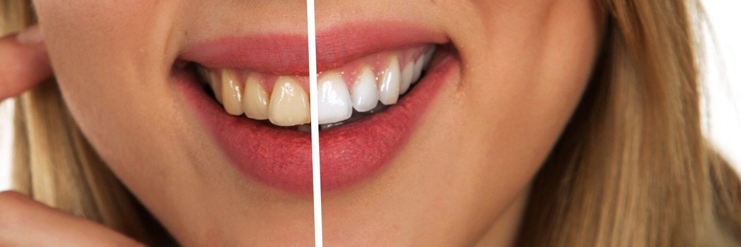 REMÉDIO PARA SENSIBILIDADE NOS DENTES APÓS CLAREAMENTO