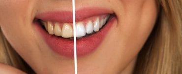 REMÉDIO PARA SENSIBILIDADE NOS DENTES APÓS CLAREAMENTO