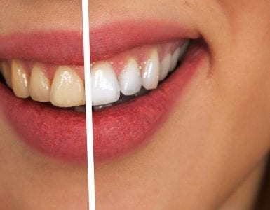 REMÉDIO PARA SENSIBILIDADE NOS DENTES APÓS CLAREAMENTO