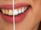 REMÉDIO PARA SENSIBILIDADE NOS DENTES APÓS CLAREAMENTO