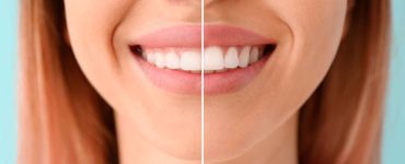 Gengivoplastia
