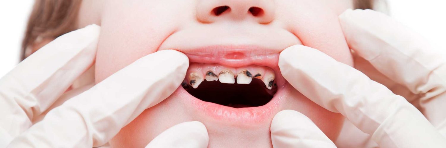 dente podre
