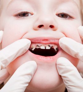 dente podre