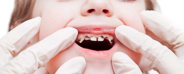 dente podre