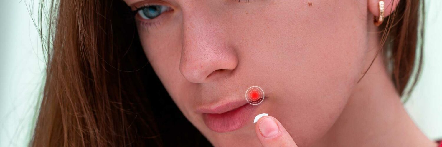 Herpes labial