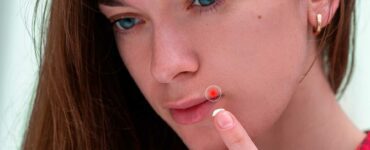 Herpes labial