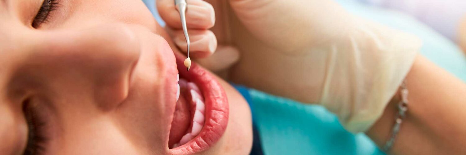 Restauração dental