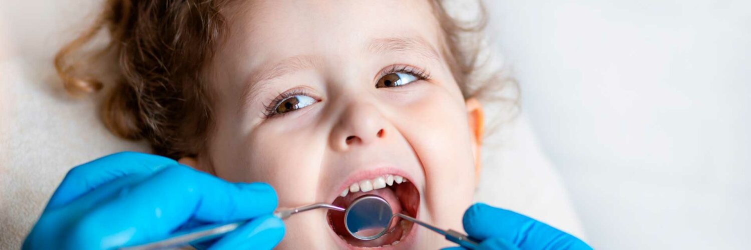Hipomineralização molar incisivo