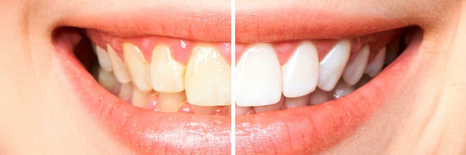 Clarear os dentes
