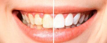 Clarear os dentes