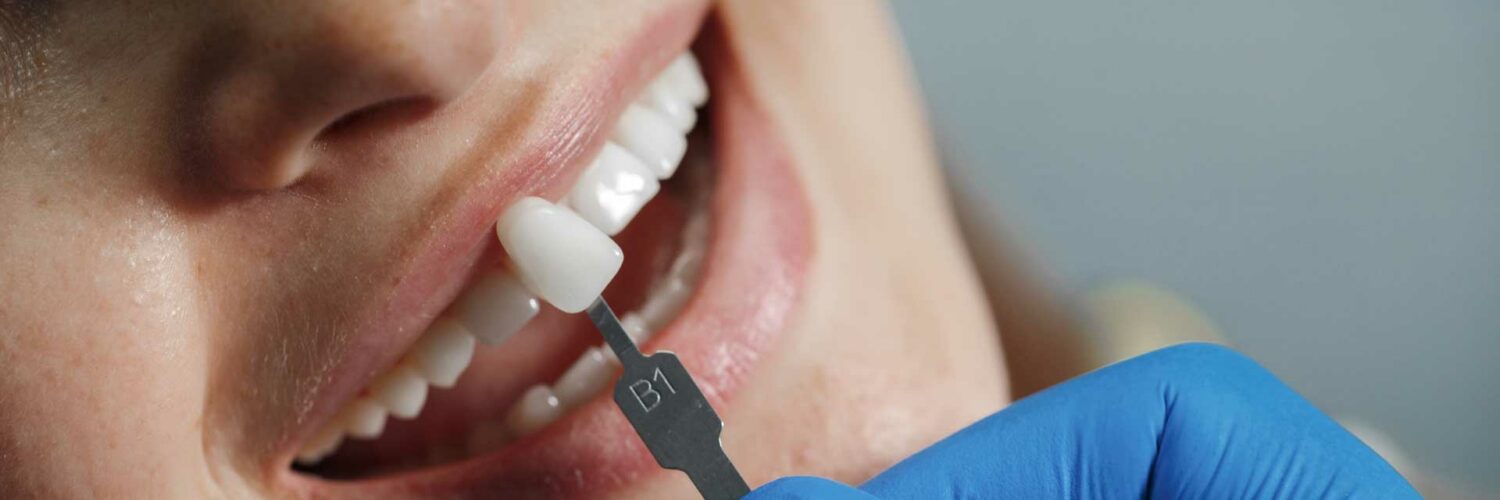 facetas de resina estragam os dentes