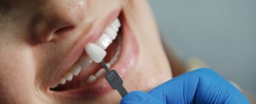facetas de resina estragam os dentes